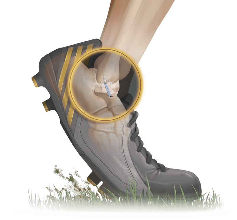 AO法 骨折治療 Foot and Ankle AO法骨折治療 Foot and Ankle [英語版Web付録付] (AOTRAUMA